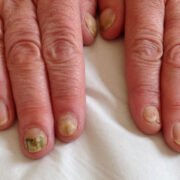 What Is the Best Treatment for Nail Fungus