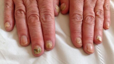What Is the Best Treatment for Nail Fungus