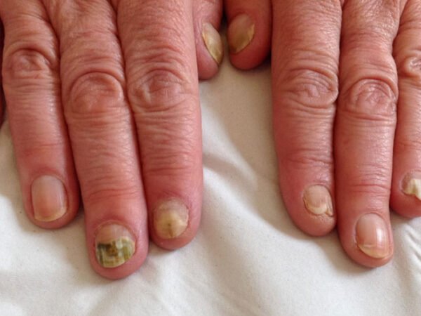 What Is the Best Treatment for Nail Fungus
