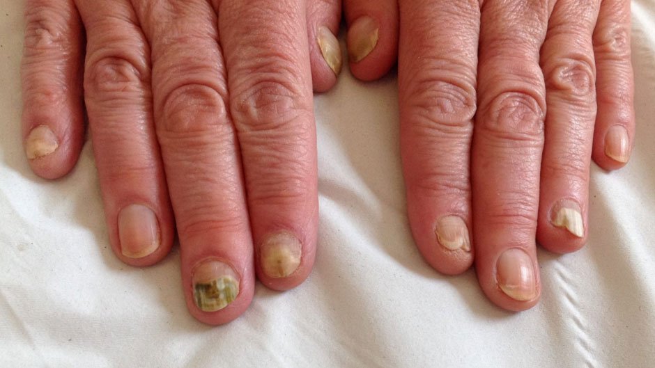 What Is the Best Treatment for Nail Fungus
