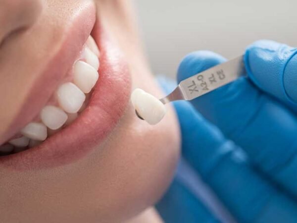 How Dental Crowns Can Transform Your Smile